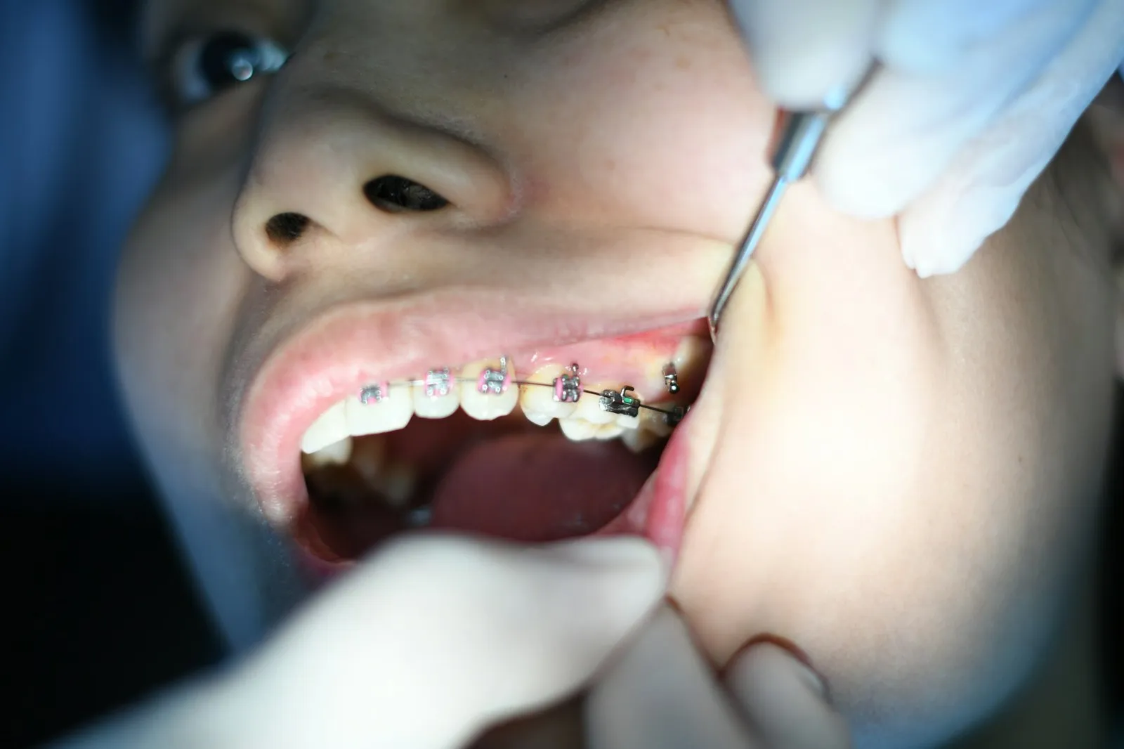 Diş hekiminin metal diş teli takılı hastanın braketlerini kontrol etmesi