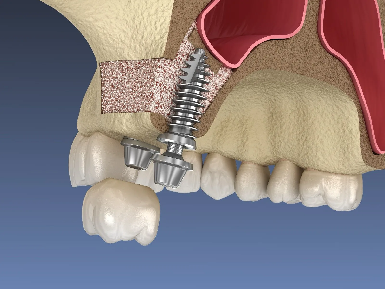 Sinüs lifting ve kemik grefti ile desteklenen üst çene implantının üç boyutlu çizimi